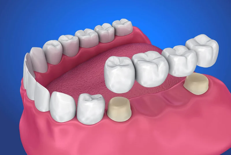 Restorative Dental Crowns and Bridges at Cosmic Dental Clinic Puchong