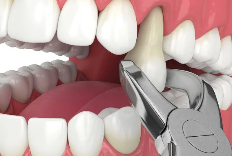Gentle Tooth Extraction Procedure at Cosmic Dental Clinic