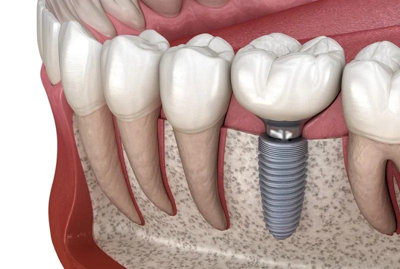 Permanent Titanium Dental Implants at Cosmic Dental Clinic Puchong
