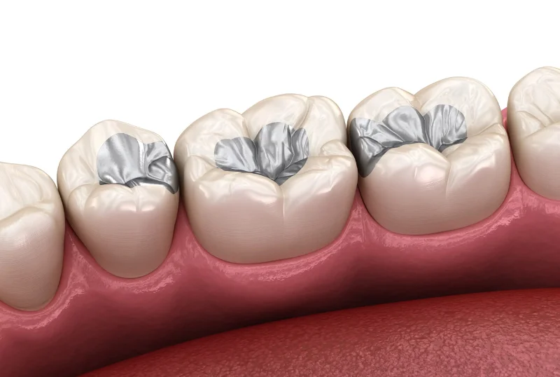 Tooth-Colored Composite Dental Fillings at Cosmic Dental Clinic