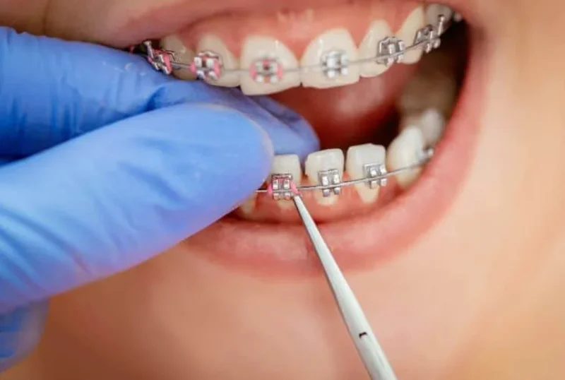 Orthodontic Dental Braces Treatment at Cosmic Dental Clinic Puchong