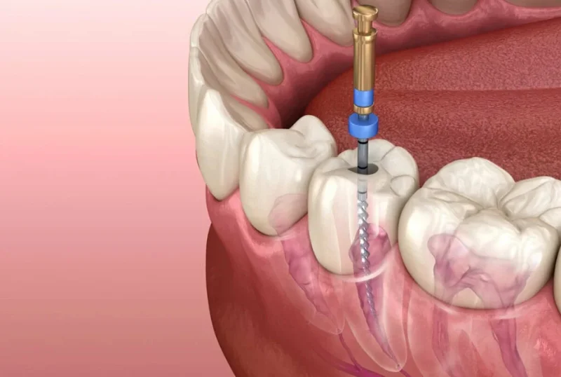 Painless Root Canal Treatment Service at Cosmic Dental Clinic Puchong