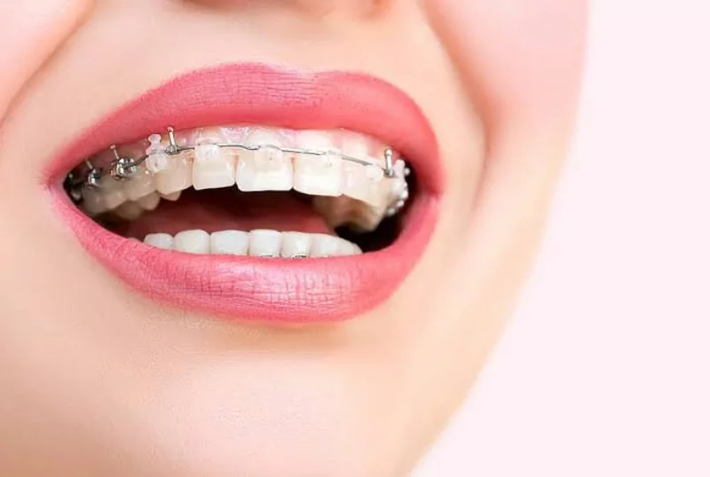 Self-Ligating Braces Orthodontic Care at Cosmic Dental Clinic