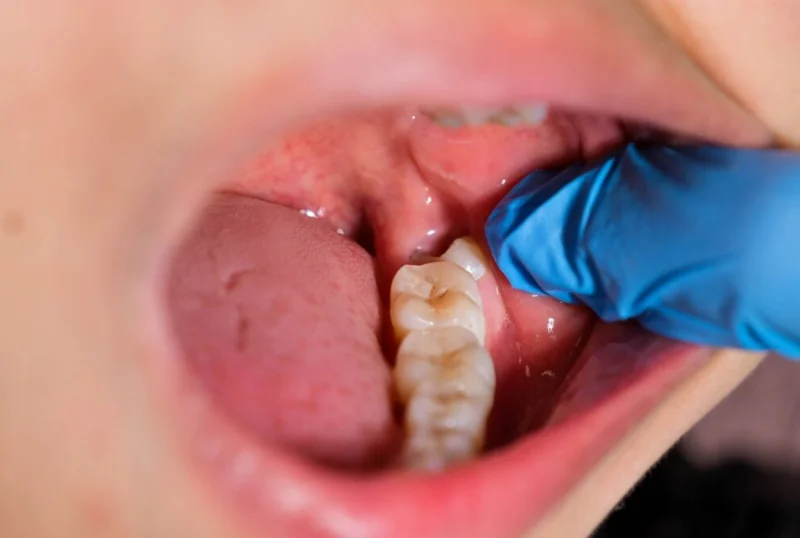 Impacted Wisdom Tooth Surgical Removal at Cosmic Dental Clinic Puchong